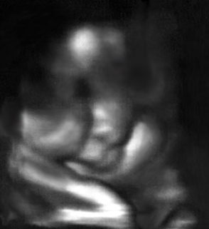 Ultrasound July 11, 2006